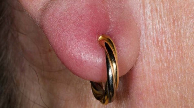 Close-up image of an infected earlobe with a gold and black twisted hoop earring; the ear appears swollen, red, and irritated around the piercing area.