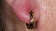 Close-up image of an infected earlobe with a gold and black twisted hoop earring; the ear appears swollen, red, and irritated around the piercing area.
